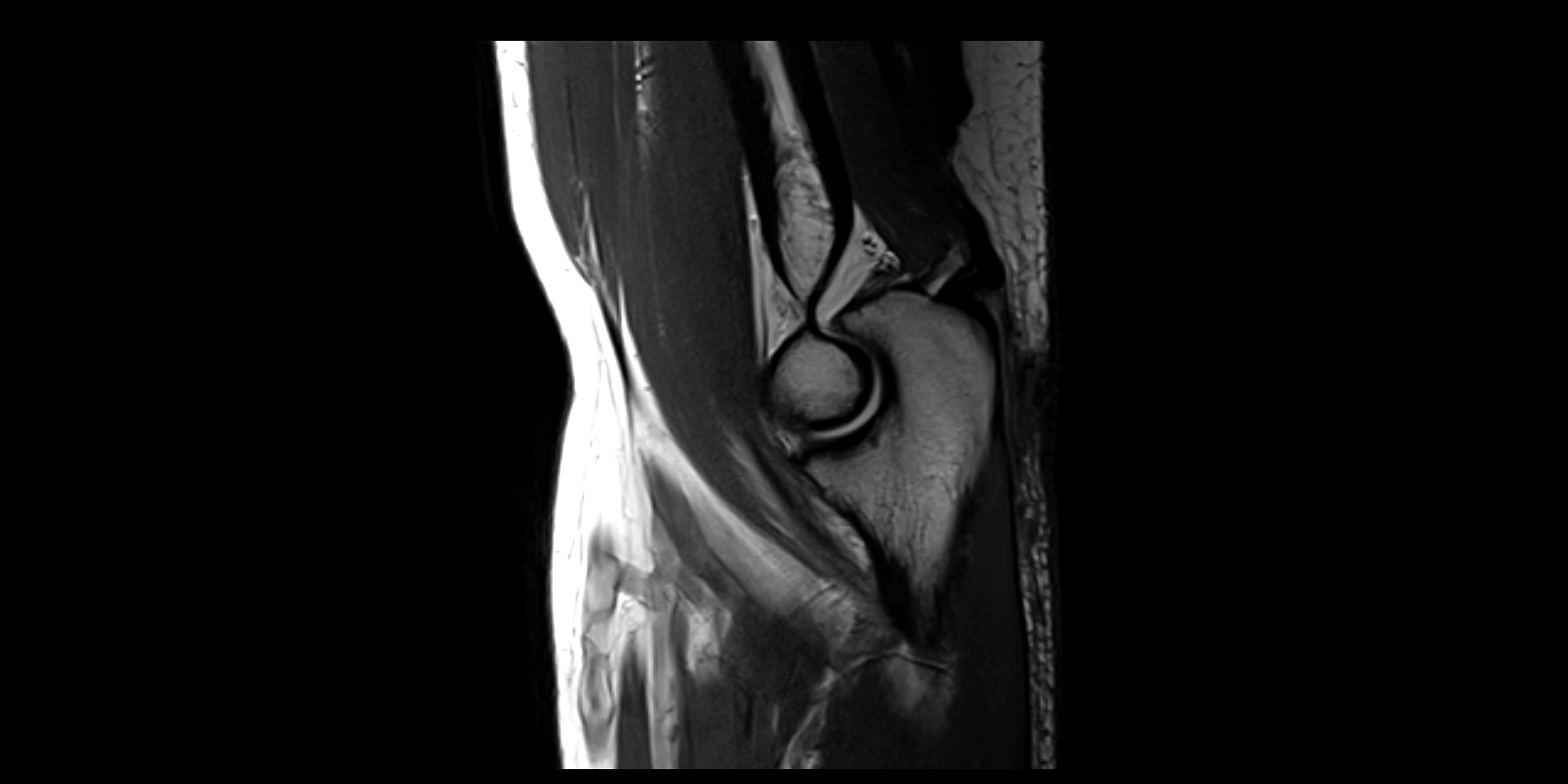 MRI elbow sagittal cross sectional anatomy 3T radiology  image-img-00001-00013.webp